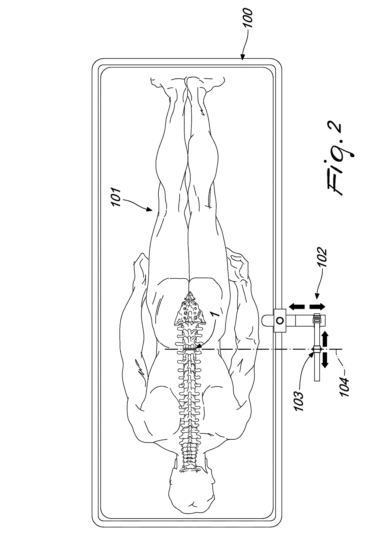 Intervertebral prosthesis, apparatus for implanting intervertebral prostheses and surgical method for implanting intervertebral prostheses, particularly for percutaneous minimally-invasive surgical procedures