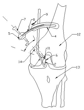 Knee joint anterior and posterior cruciate ligament femoral tunnel positioner