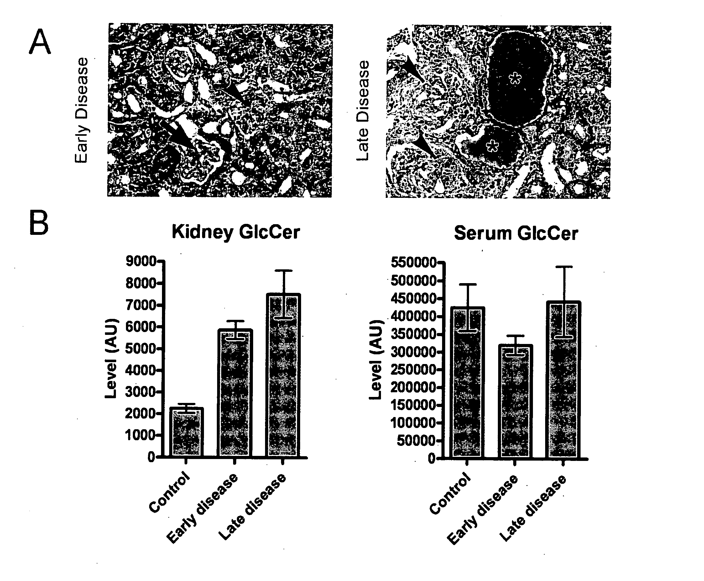 Glucosylceramide Synthase Inhibition For The Treatment Of Collapsing Glomerulopathy And Other Glomerular Disease