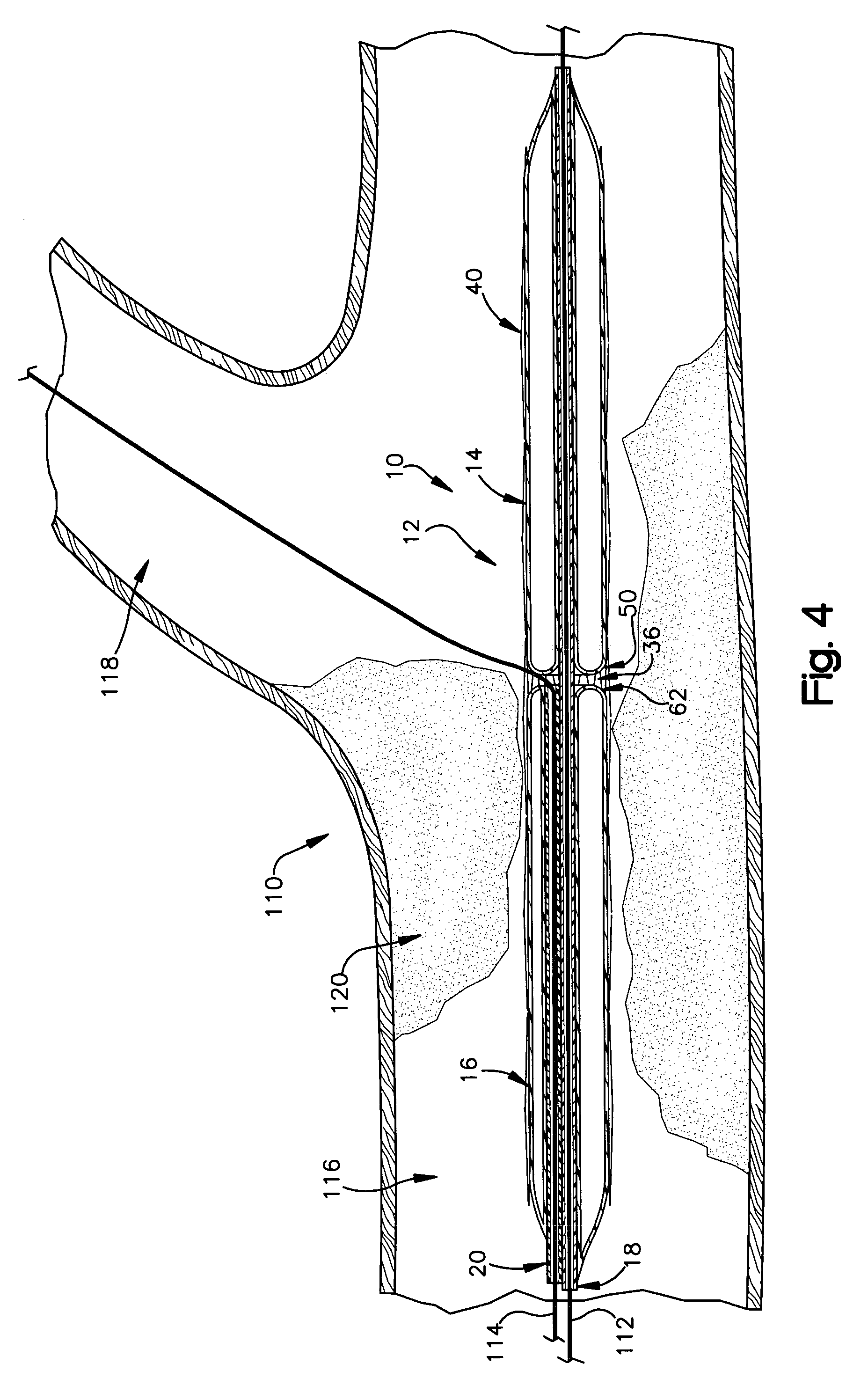 Apparatus for treating atherosclerosis