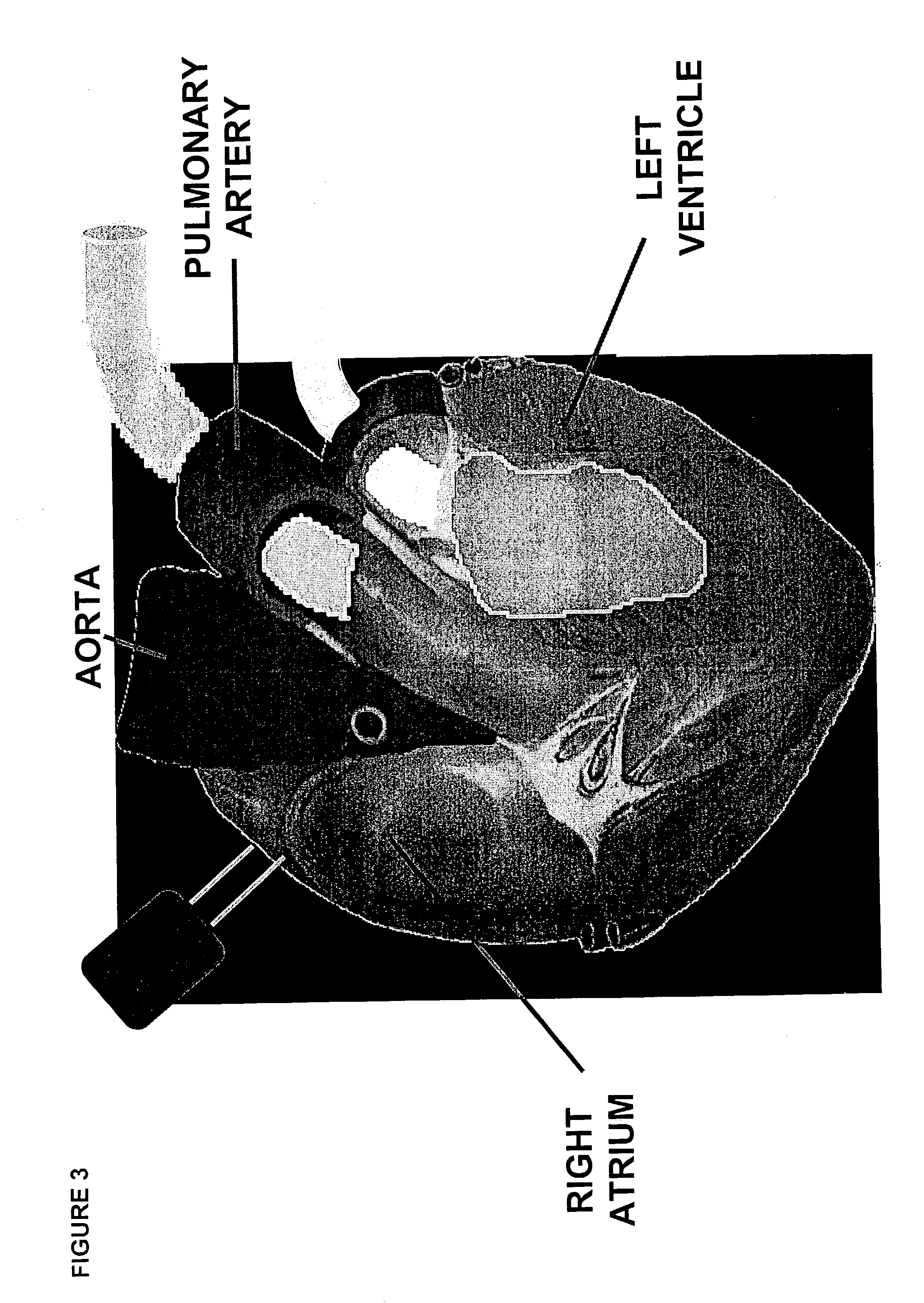 Methods and compositions for the treatment of ischemic reperfusion