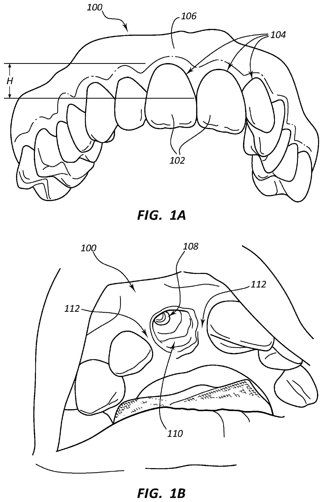 Dental implants with markers for determining three-dimensional positioning