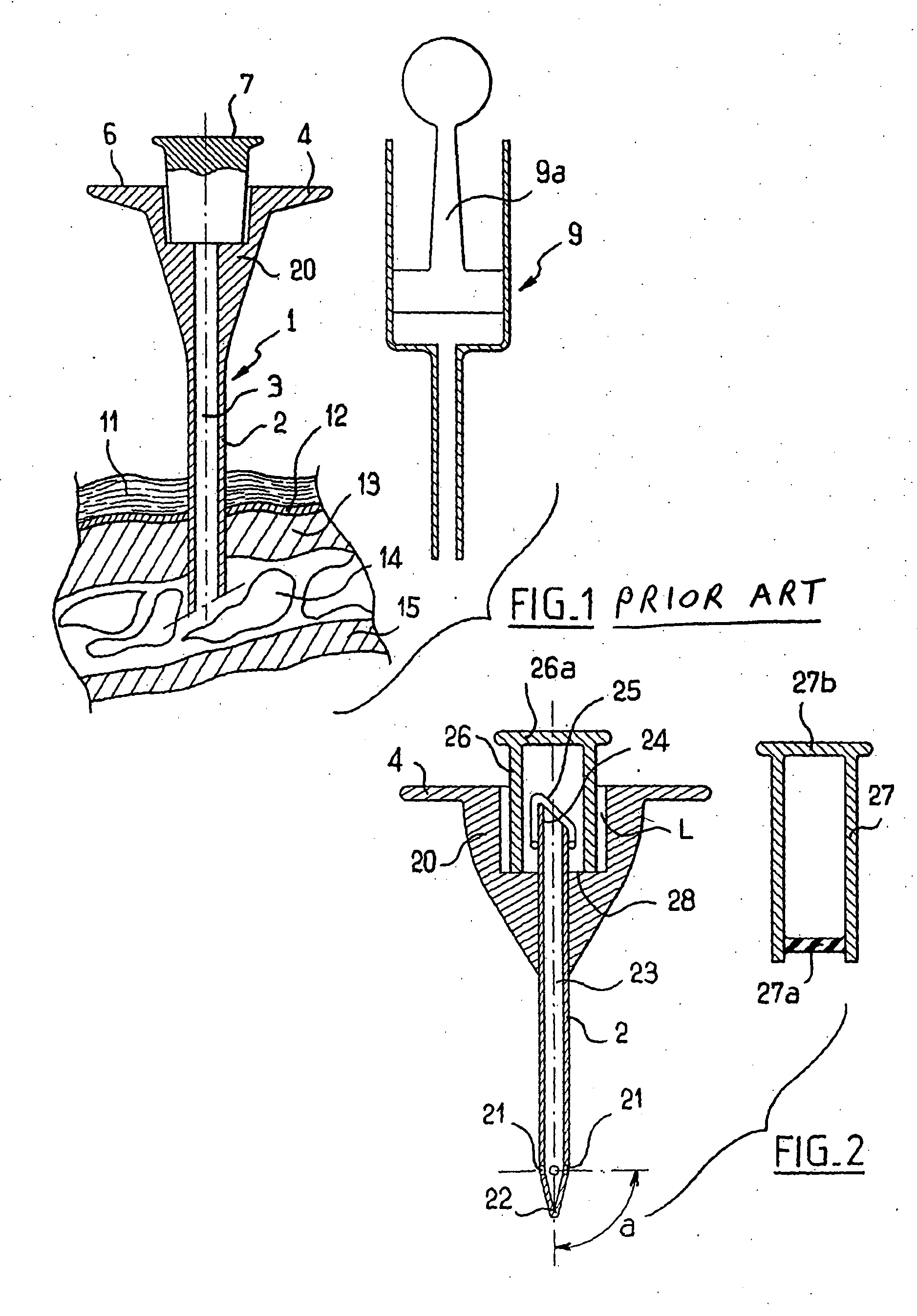 Bone Marrow Aspiration Trocar