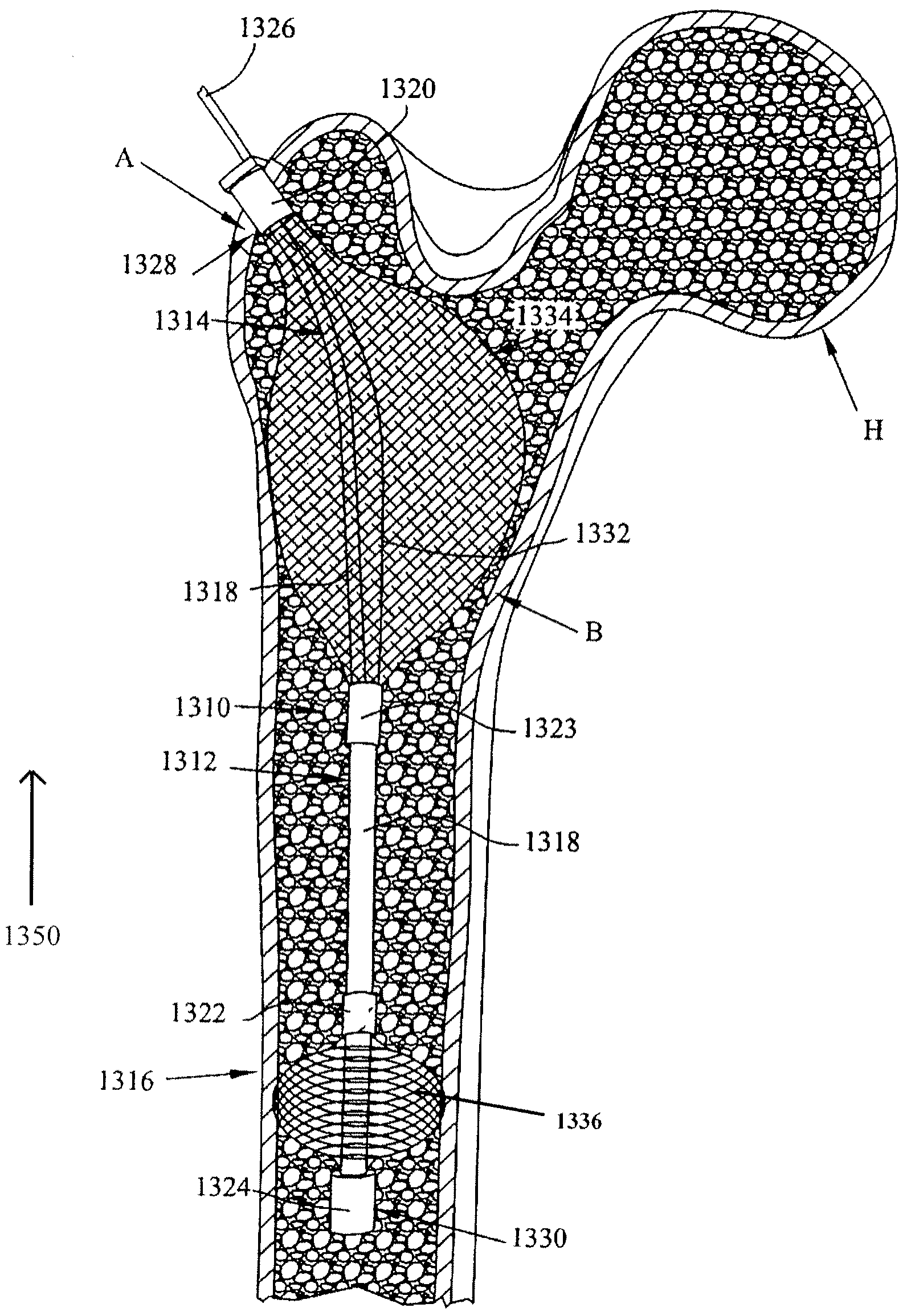 Apparatus and method for prophylactic hip fixation