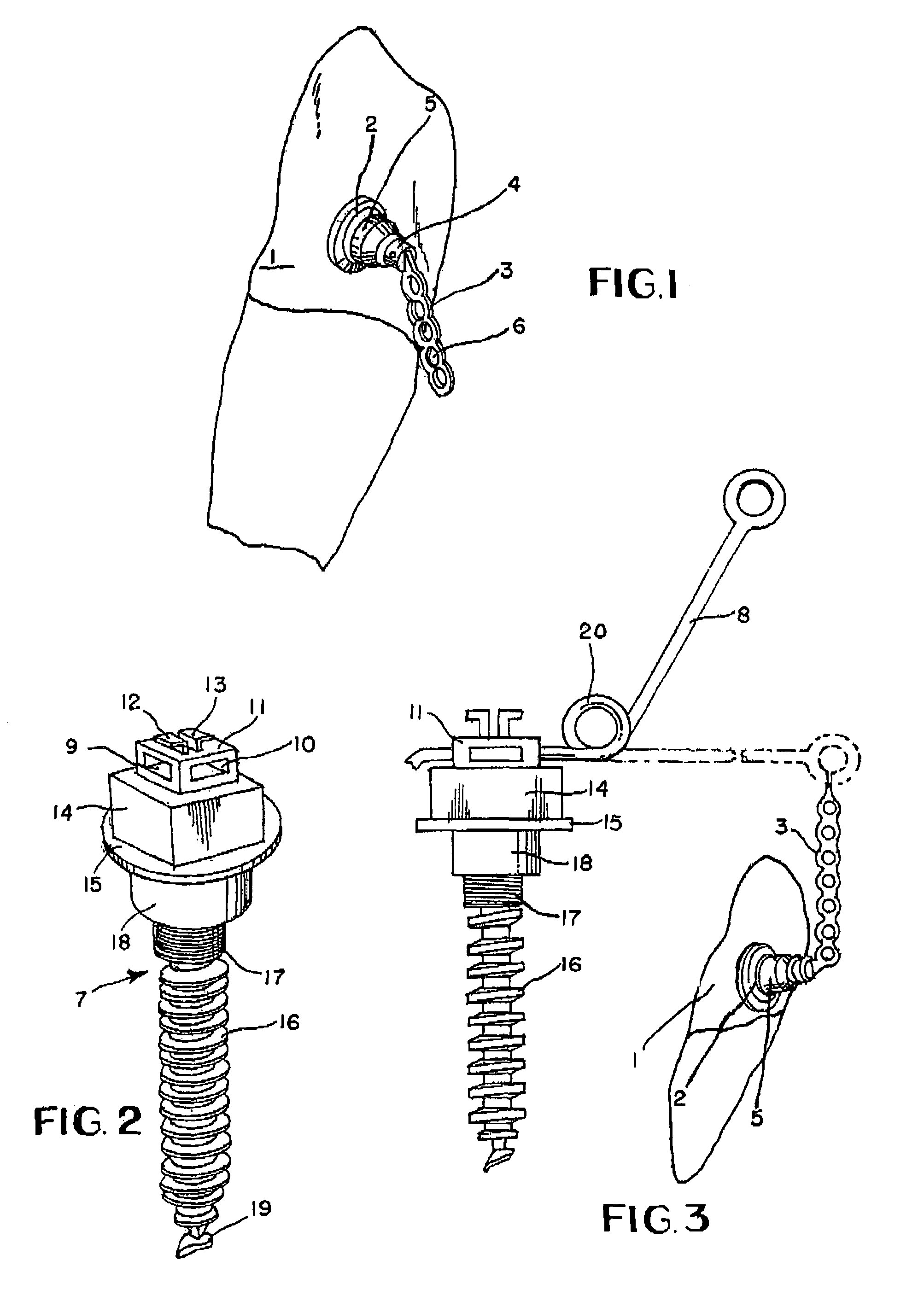 Impacted tooth appliance