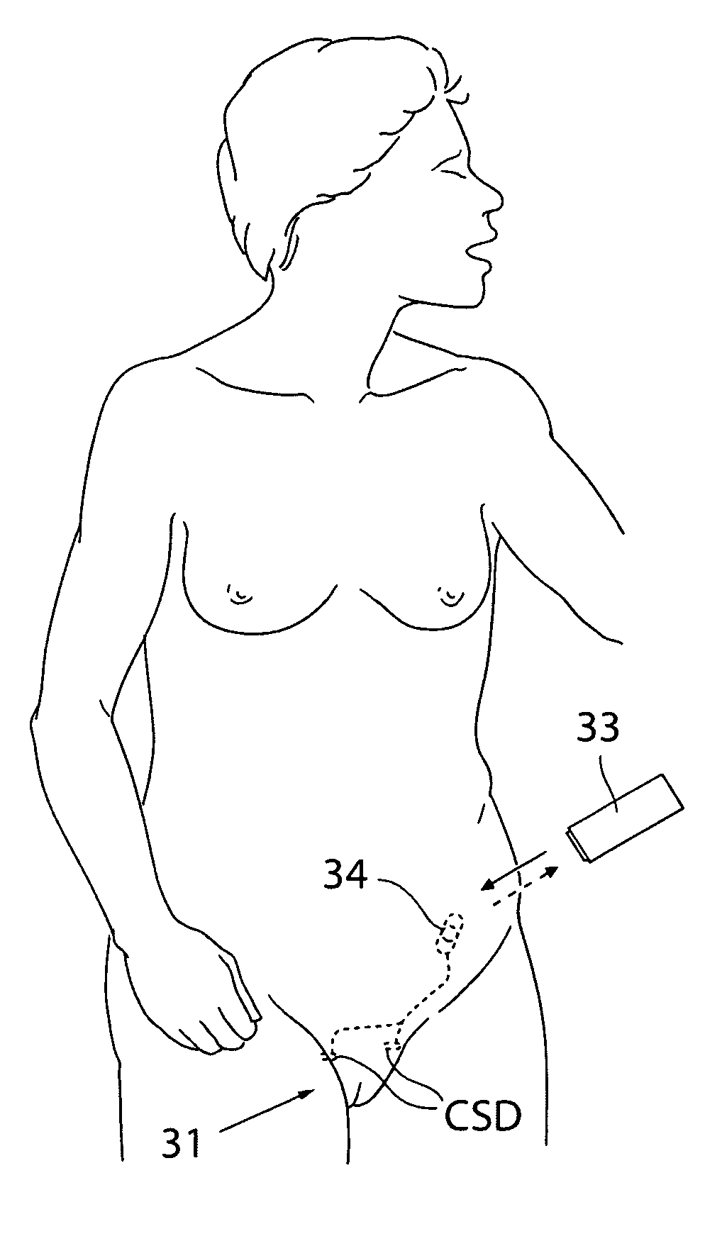 Method for treating female sexual dysfunction