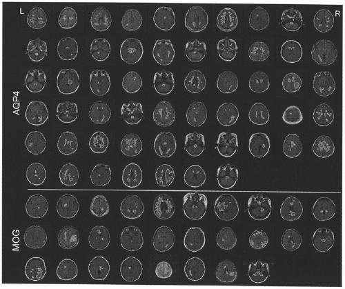 Brain lesion image spatial distribution characteristic classification and identification method based on magnetic resonance imaging