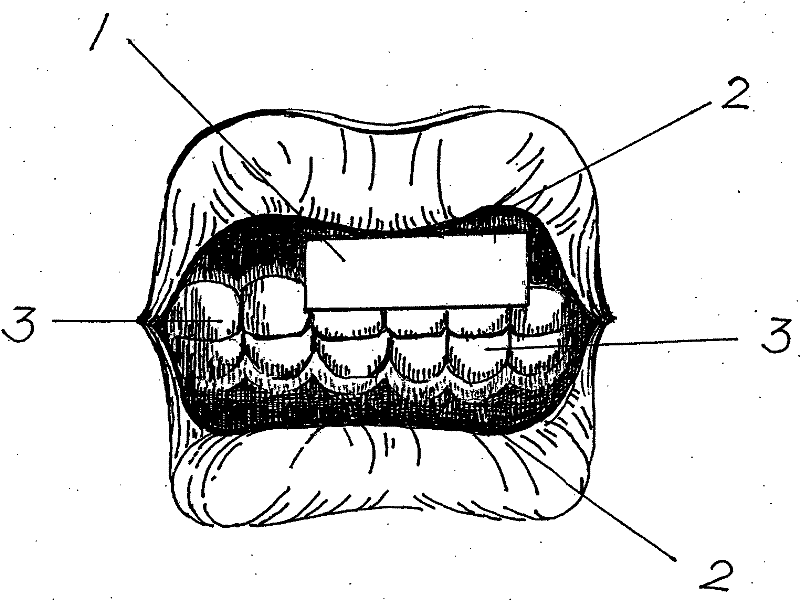 New preparation formulation-paper patch used for preventing diseases of local oral cavity