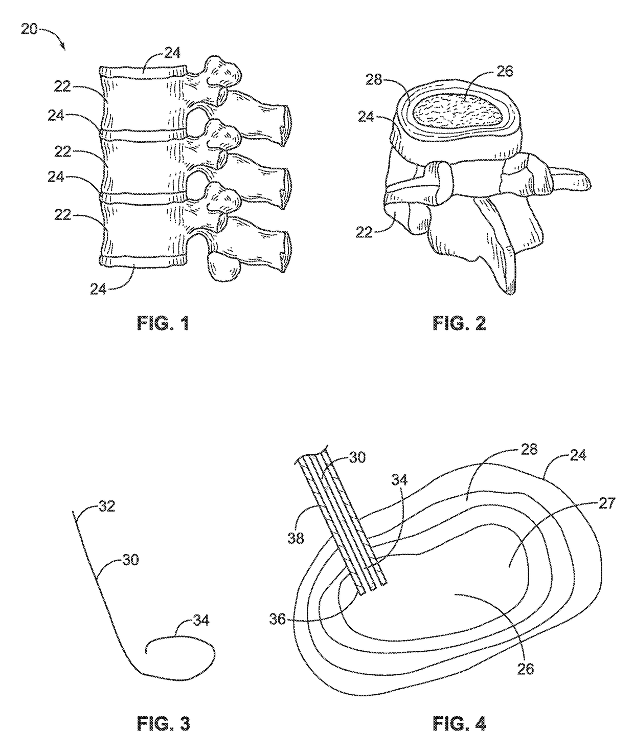 Tissue removal tools and methods of use