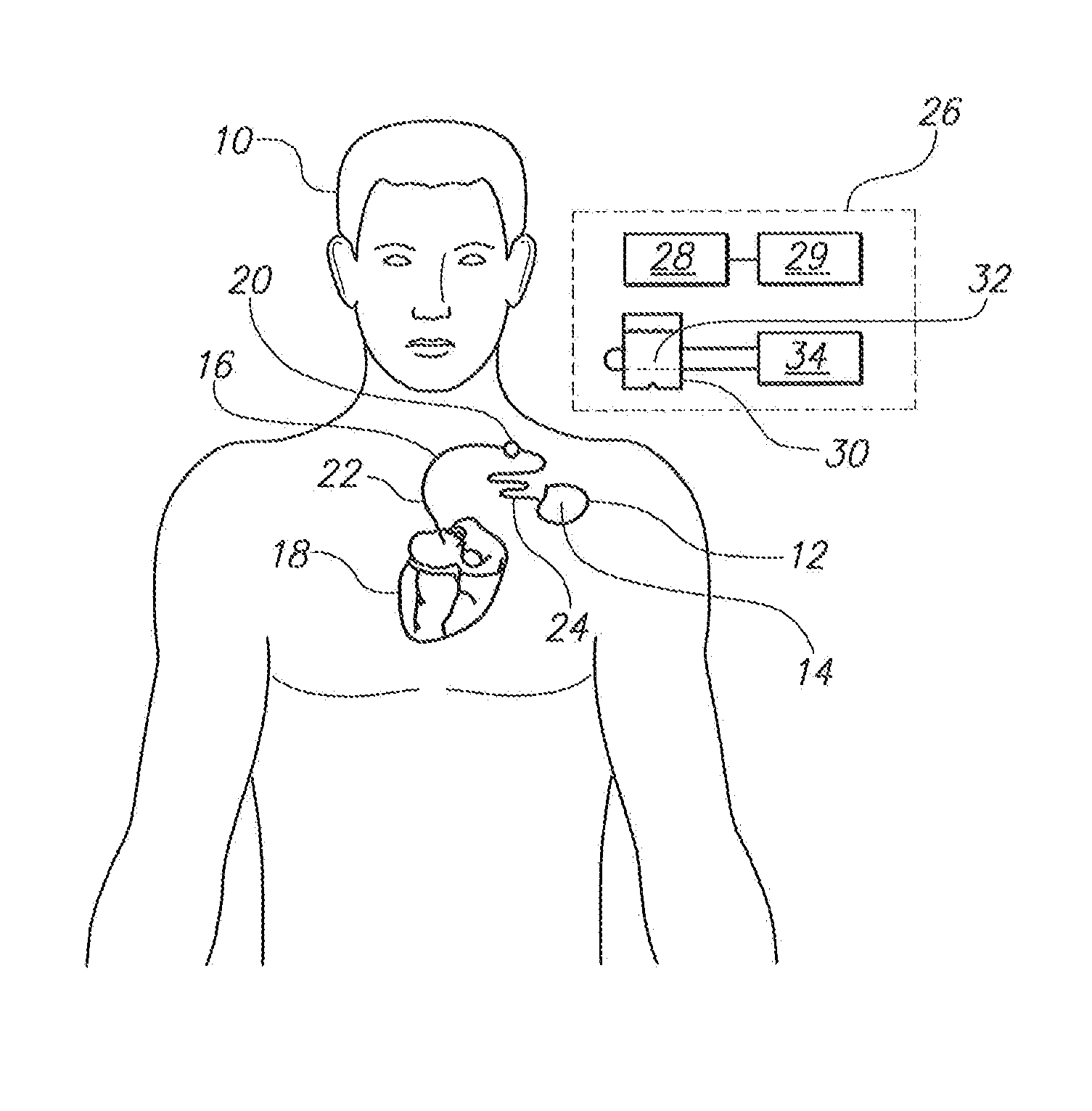 Extracorporeal Unit for Inspecting the Insulation of an Electrical Wire of an Implanted Medical Device
