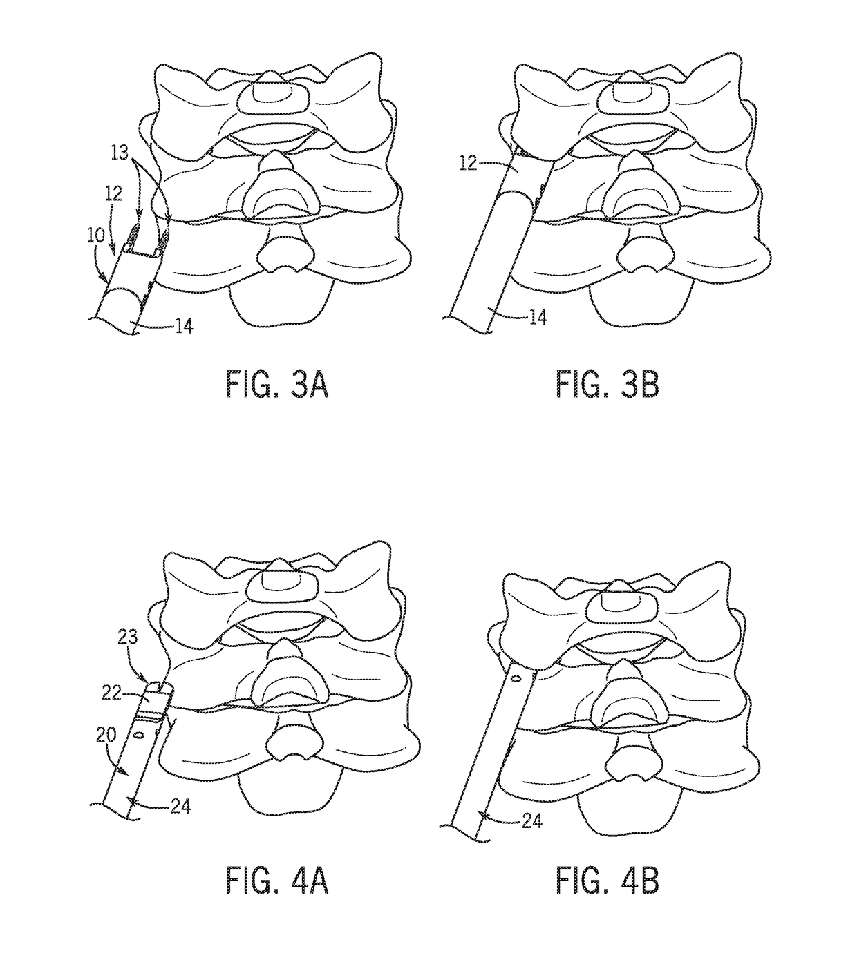 Lateral mass fixation system