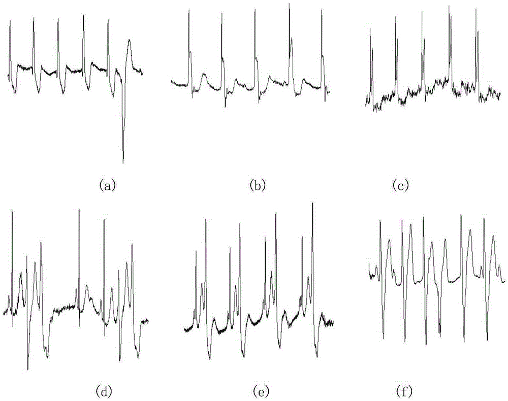 R wave rapid detection method adaptive to electrocardiogram waveform pathological change