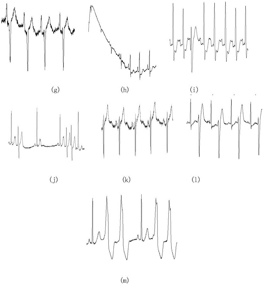 R wave rapid detection method adaptive to electrocardiogram waveform pathological change