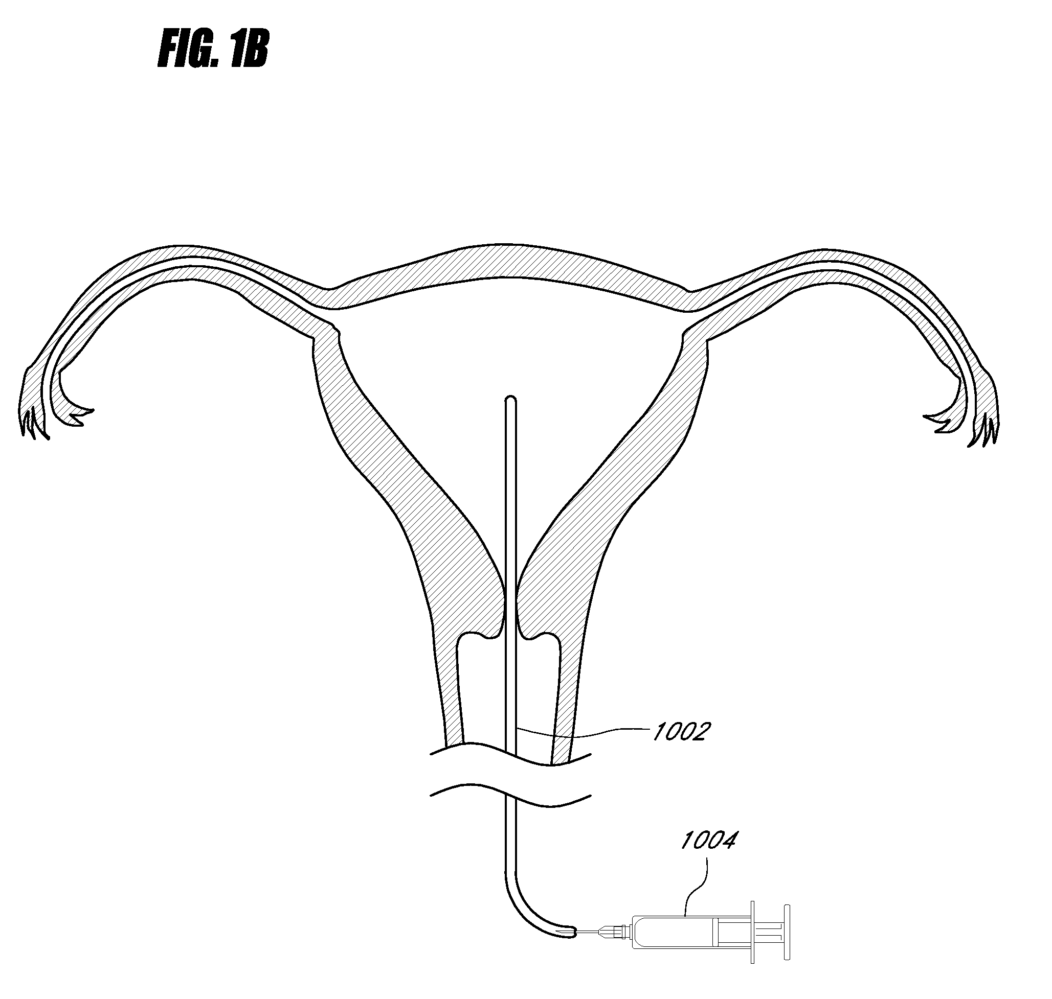 Systems, methods and devices for using a flowable medium for distending a hollow organ