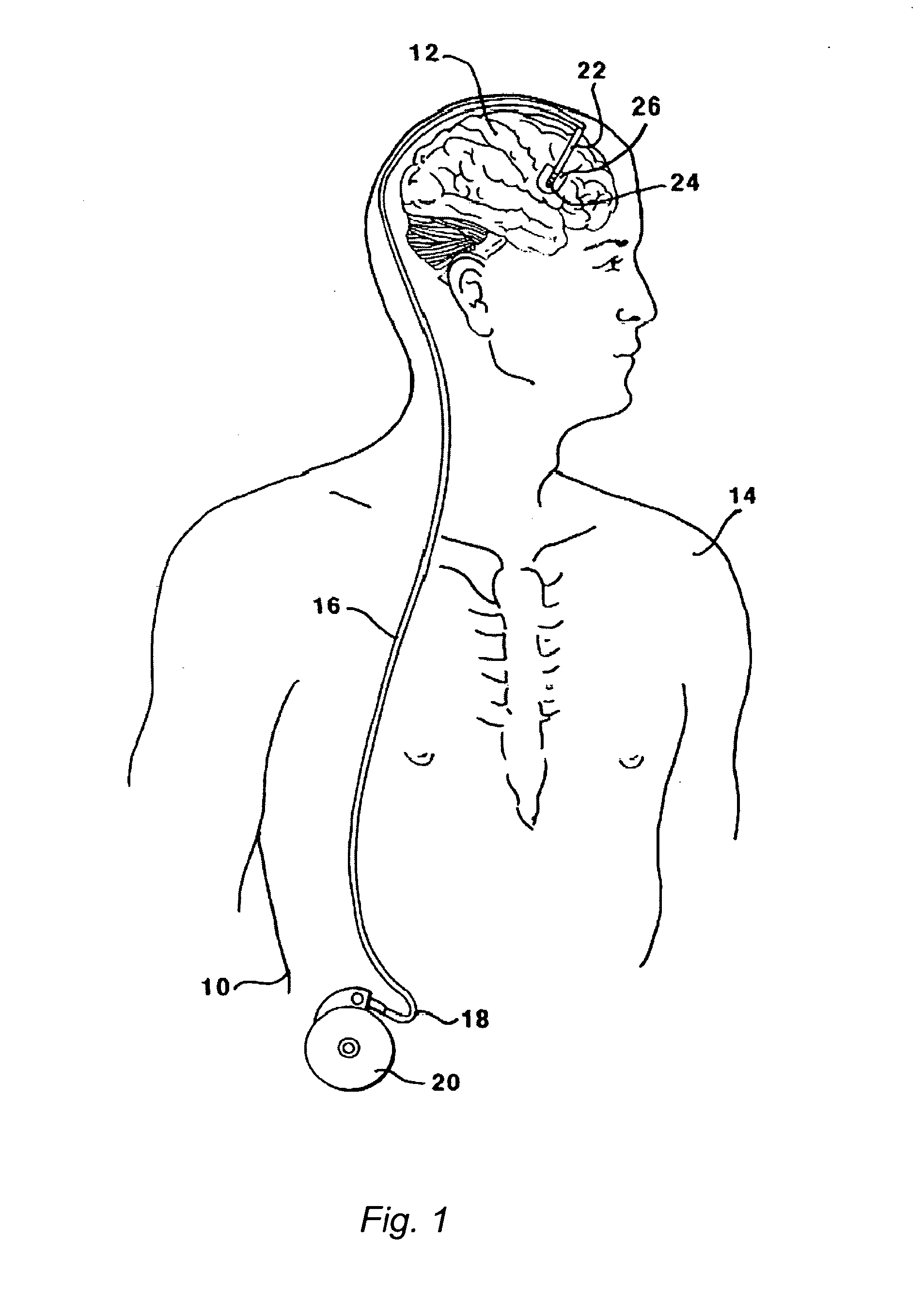 Methods and Systems for Treatment of Neurological Diseases of the Central Nervous System