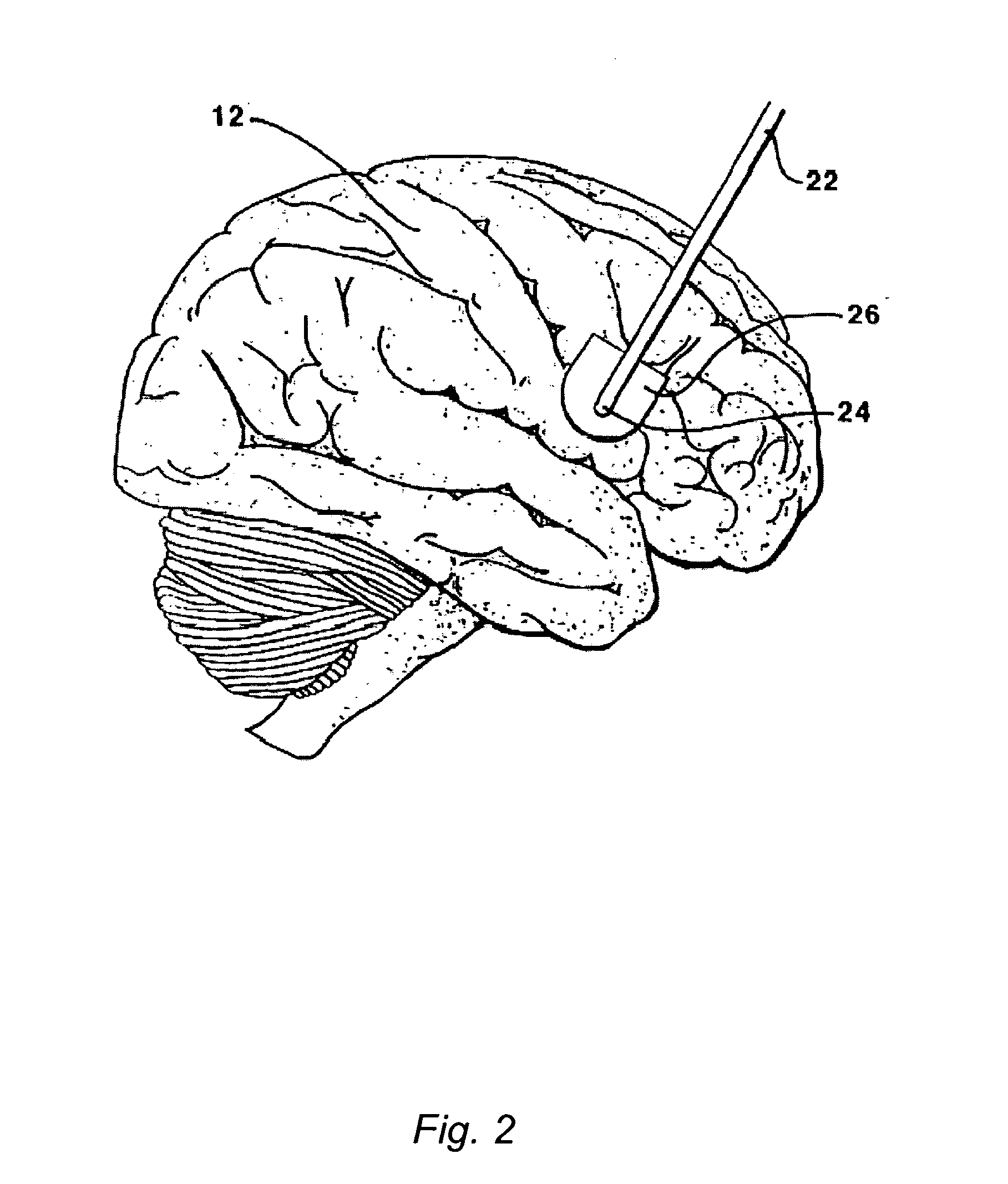 Methods and Systems for Treatment of Neurological Diseases of the Central Nervous System