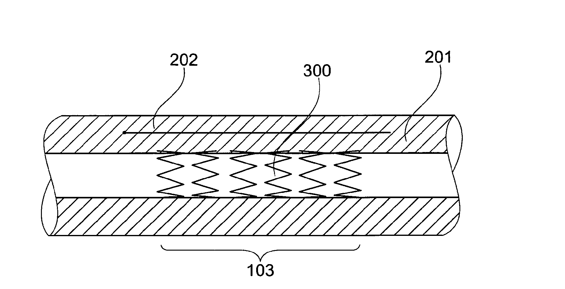 Device, And A Method For Treatment Of Increased Blood Pressure