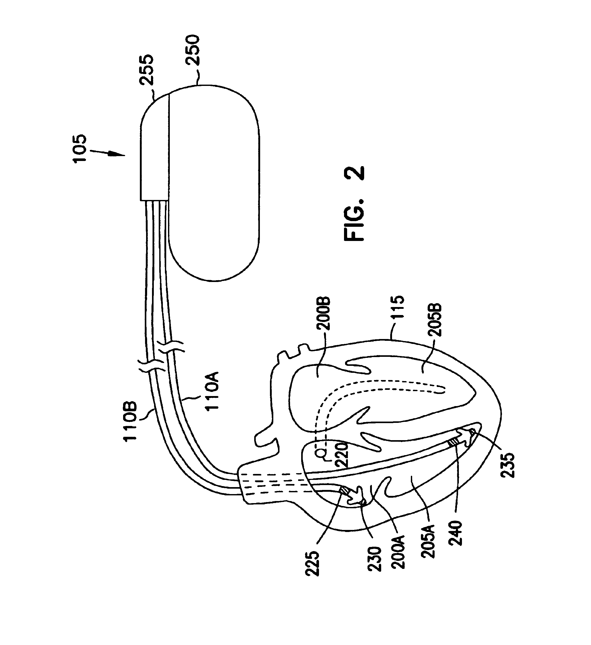 Method and apparatus for treating irregular ventricular contractions such as during atrial arrhythmia
