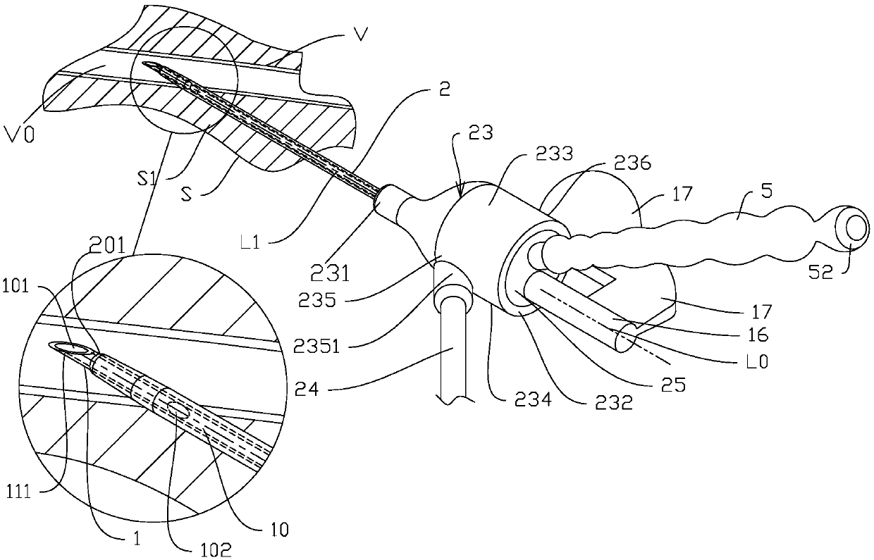 Vein duct device capable of performing plugging