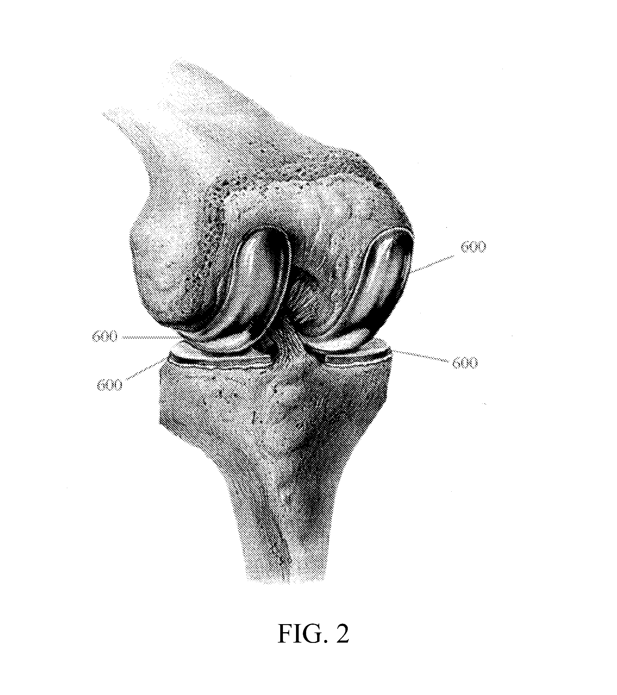 Prosthetic device and system and method for implanting prosthetic device