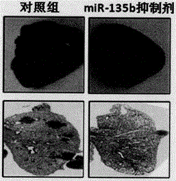 Application of miR-135b inhibitor to medicament for treating lung metastasis and relapse of osteosarcoma