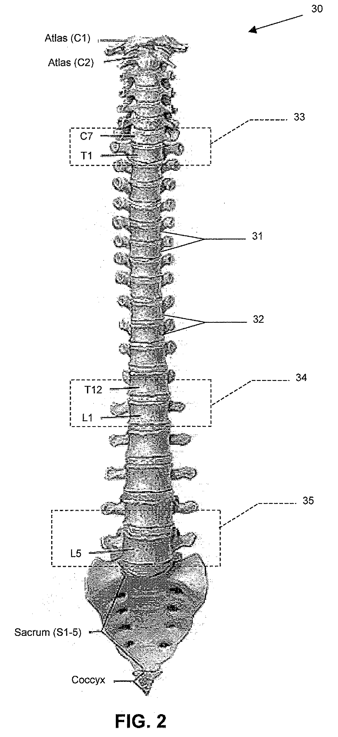 Spinal stabilization treatment methods for maintaining axial spine height and sagital plane spine balance