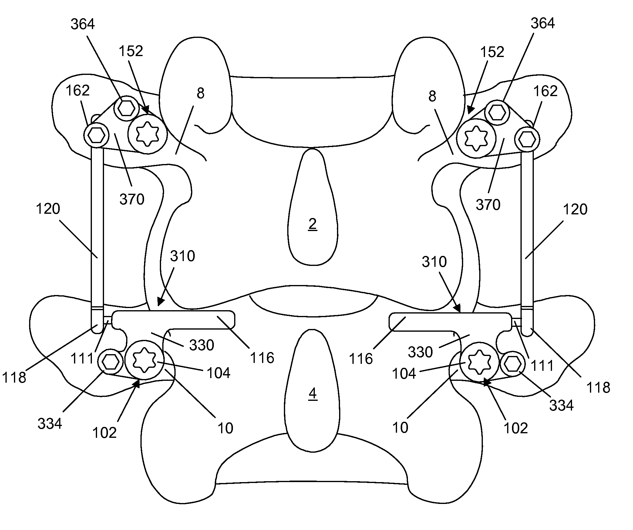 Spine implant with a dual deflection rod system including a deflection limiting sheild associated with a bone screw and method