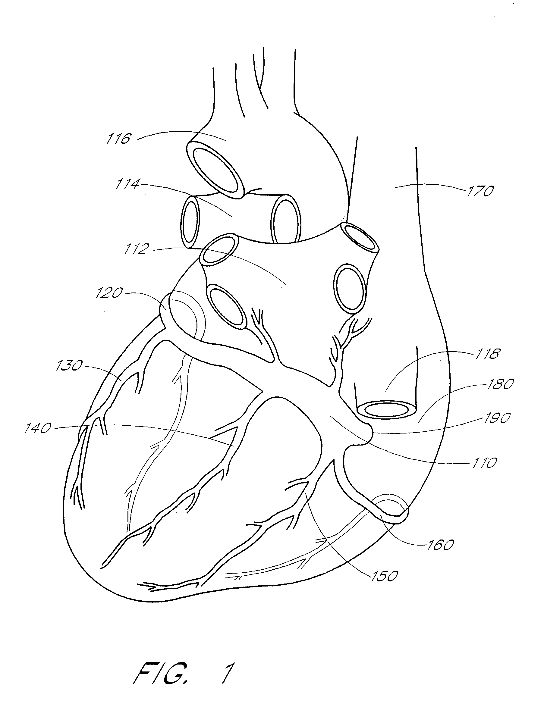 Self-anchoring coronary sinus lead