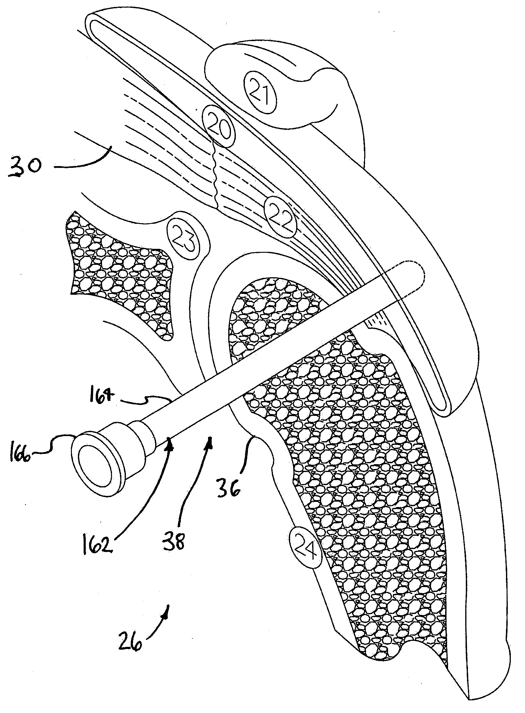 Implantable Tendon Protection Systems and Related Kits and Methods