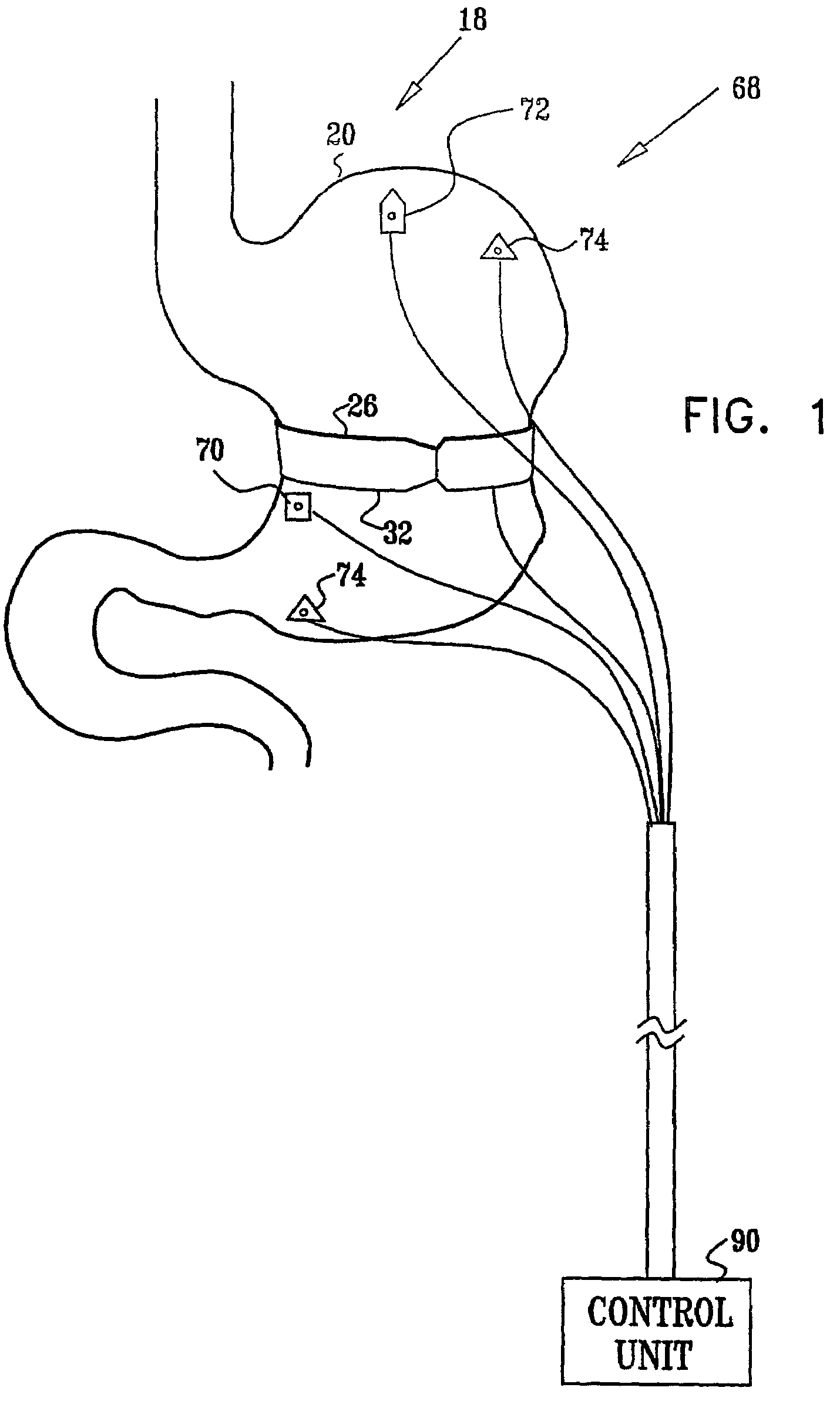 Gastrointestinal methods and apparatus for use in treating disorders