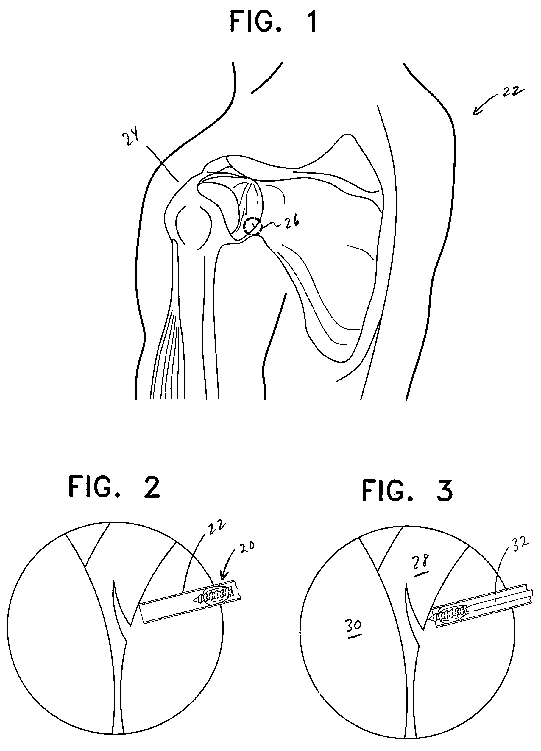 Method and apparatus for repair of torn rotator cuff tendons