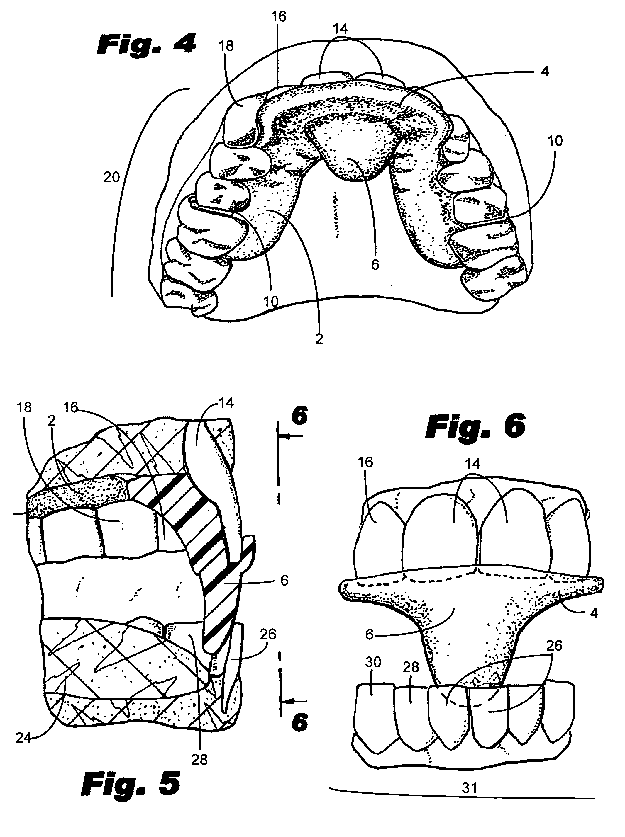 Intraoral mandibular advancement device for treatment of sleep disorders, including snoring, obstructive sleep apnea, and gastroesophageal reflux disease and method for delivering the same