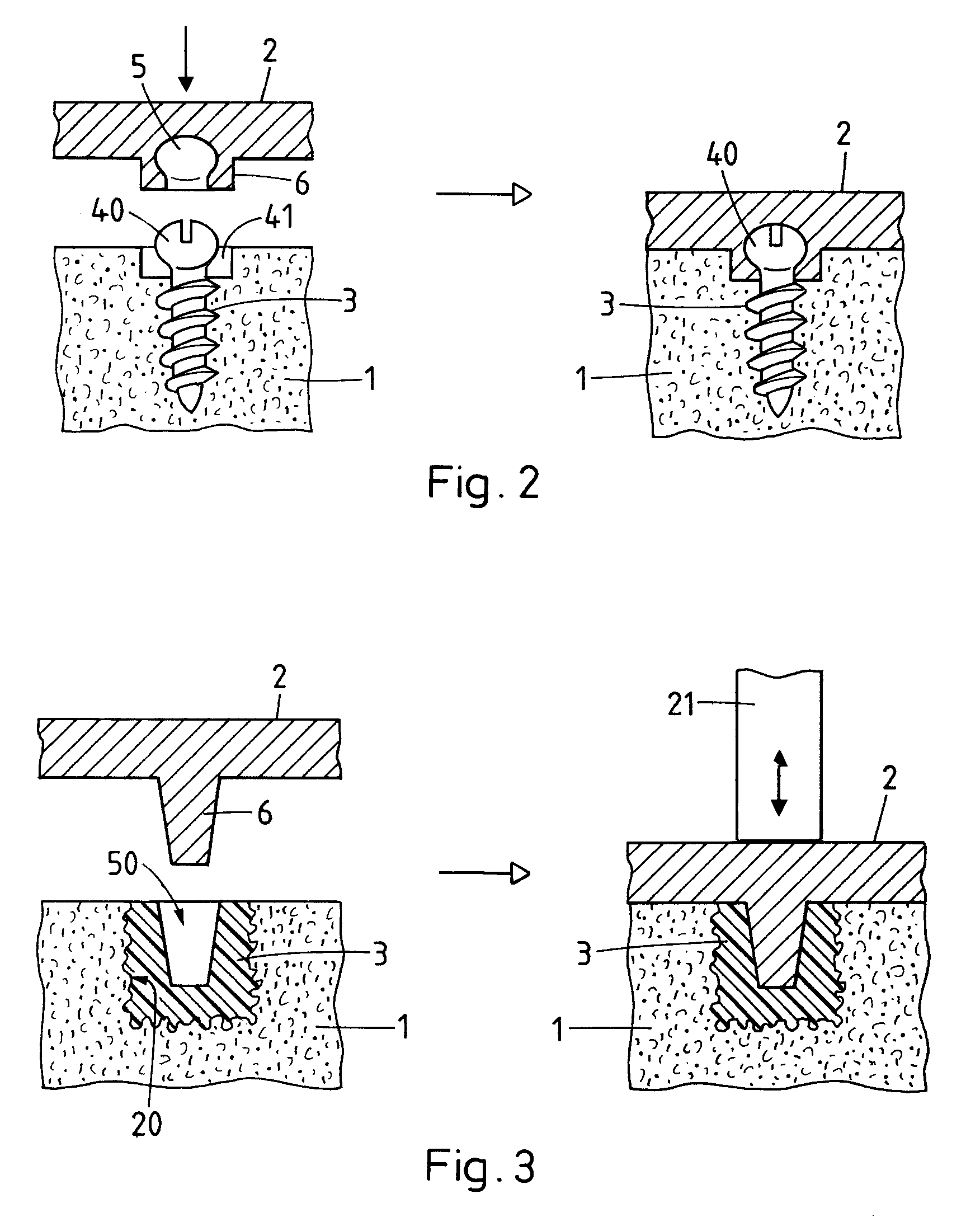 Method for fastening an implant to bone tissue and corresponding implant system