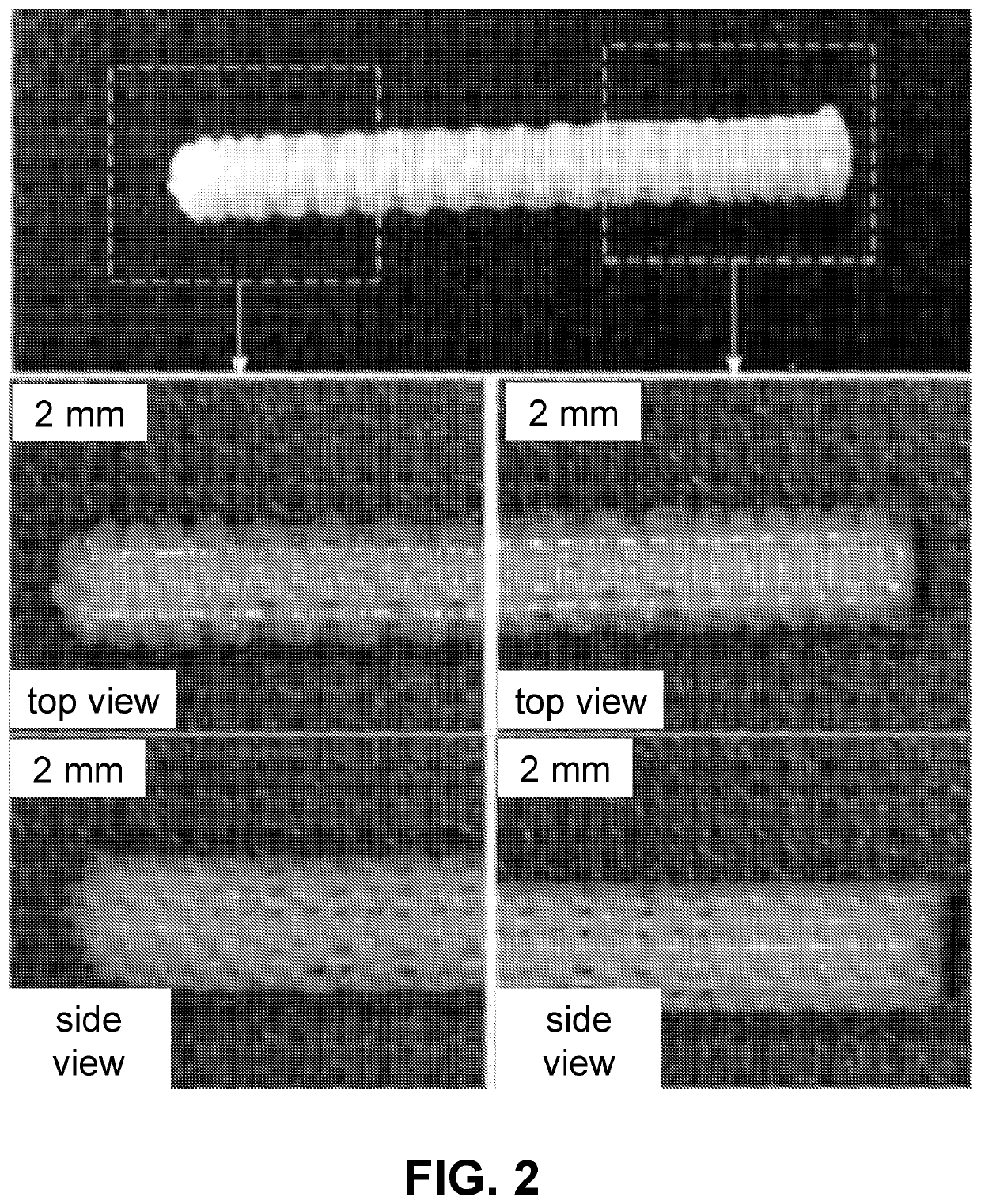 Customized load-bearing and bioactive functionally-graded implant for treatment of osteonecrosis