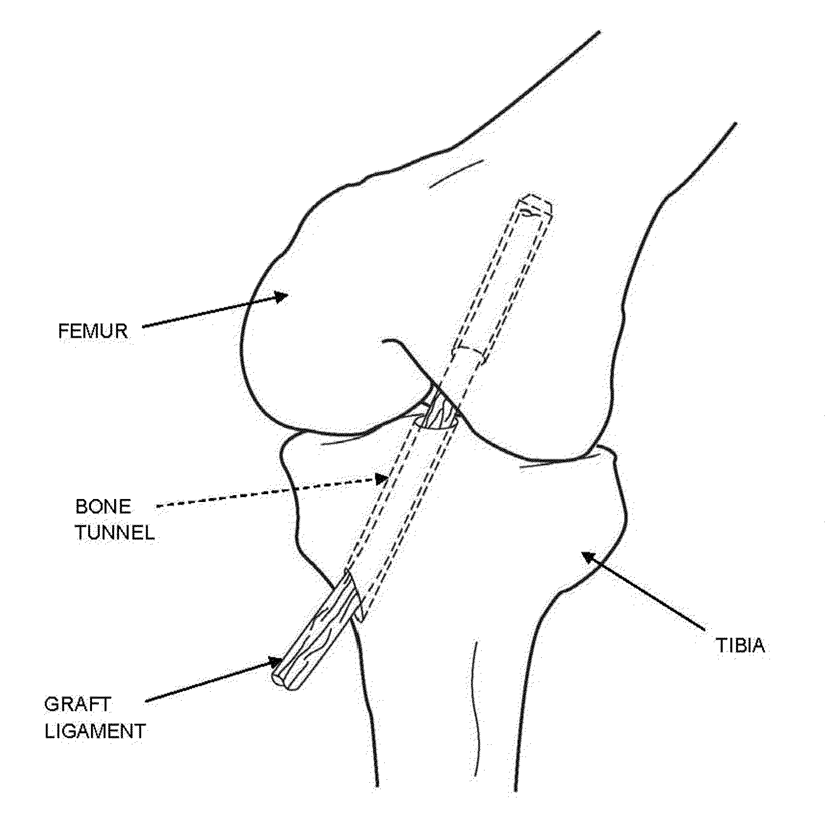 Method and apparatus for reconstructing a ligament
