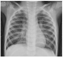 New coronal pneumonia X-ray image classification method and system based on lightweight model