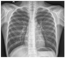 New coronal pneumonia X-ray image classification method and system based on lightweight model