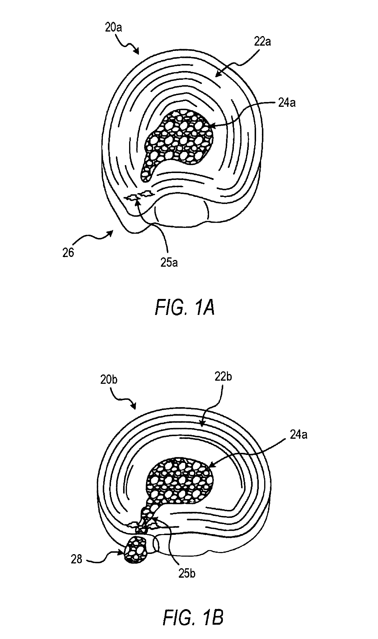 Alpha adreneric receptor agonists for treatment of degenerative disc disease