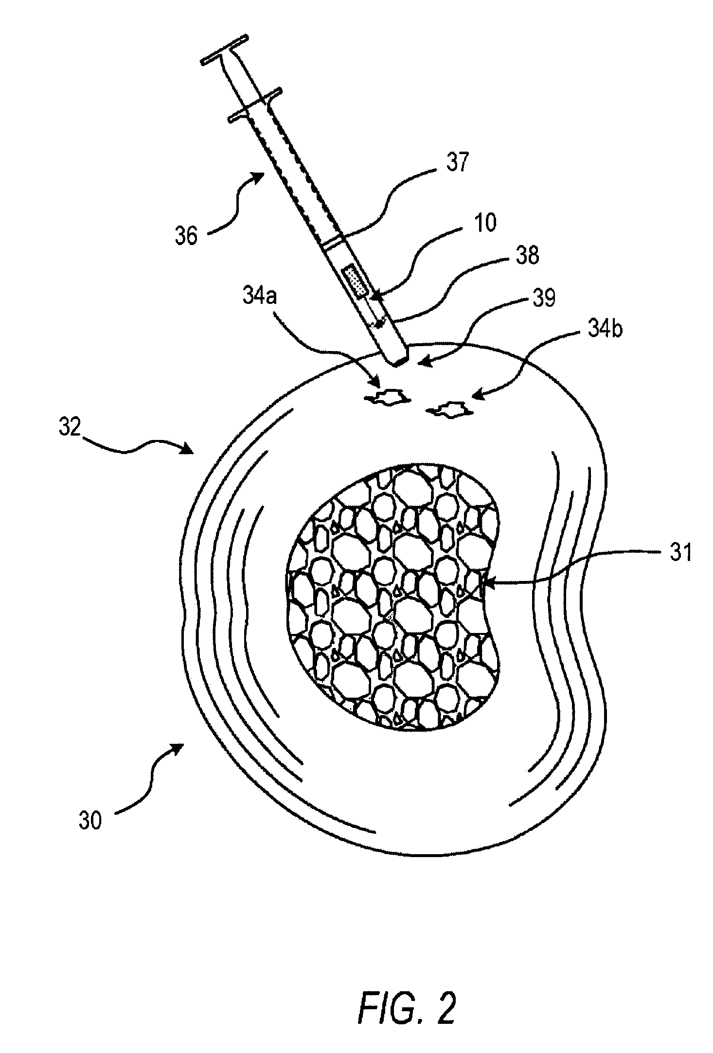 Alpha adreneric receptor agonists for treatment of degenerative disc disease