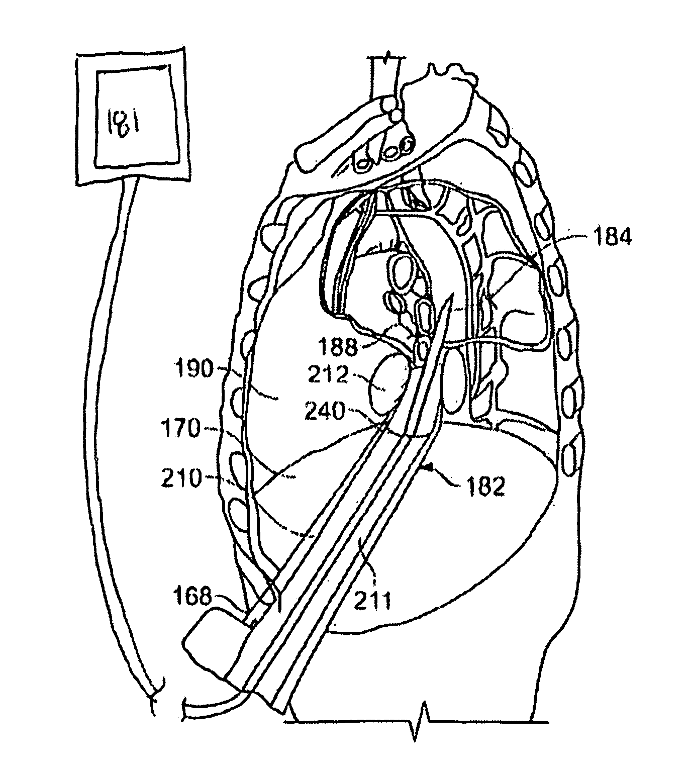 Diaphragm entry for posterior surgical access