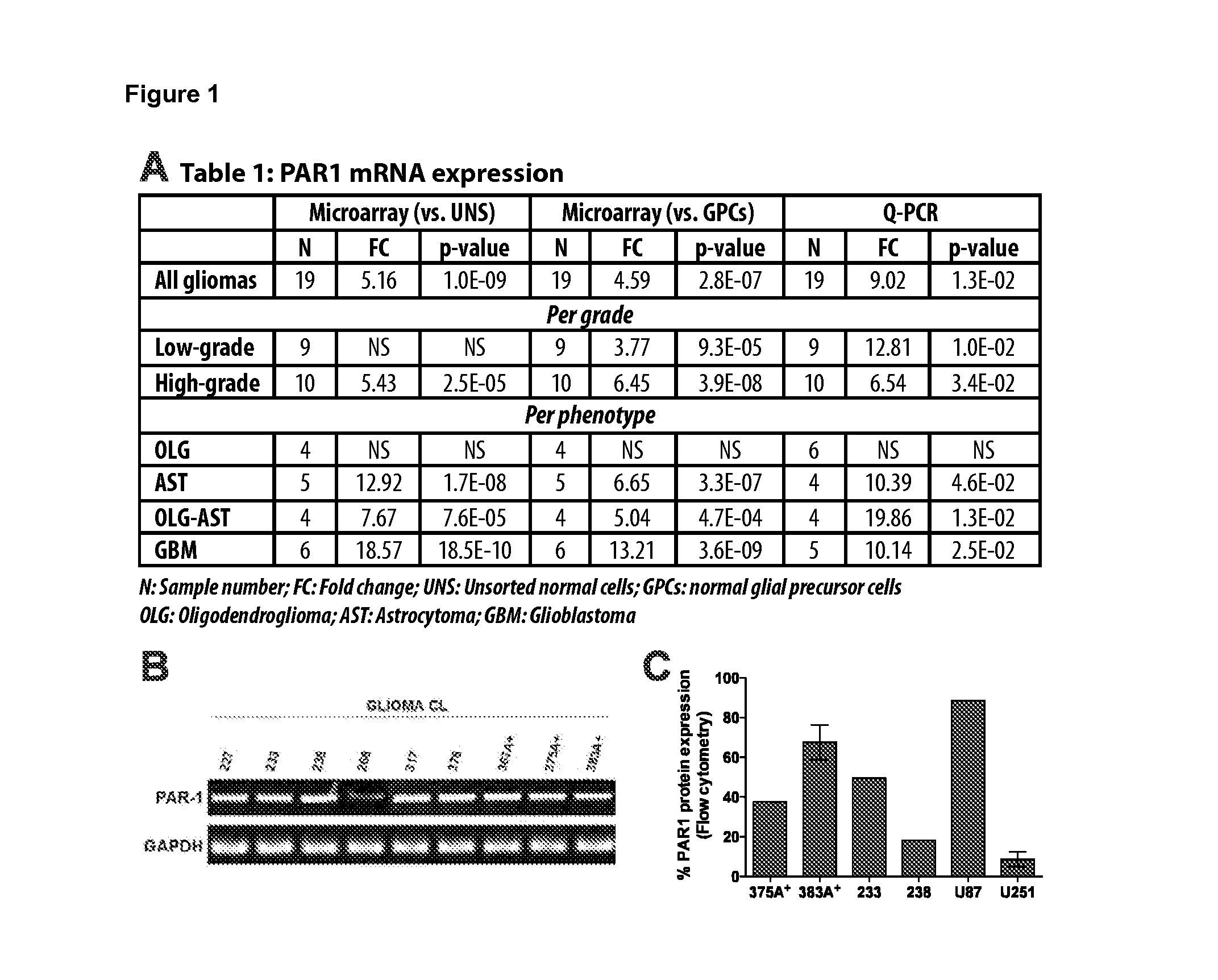 Use of inhibitors of binding between a par-1 receptor and its ligands for the treatment of glioma