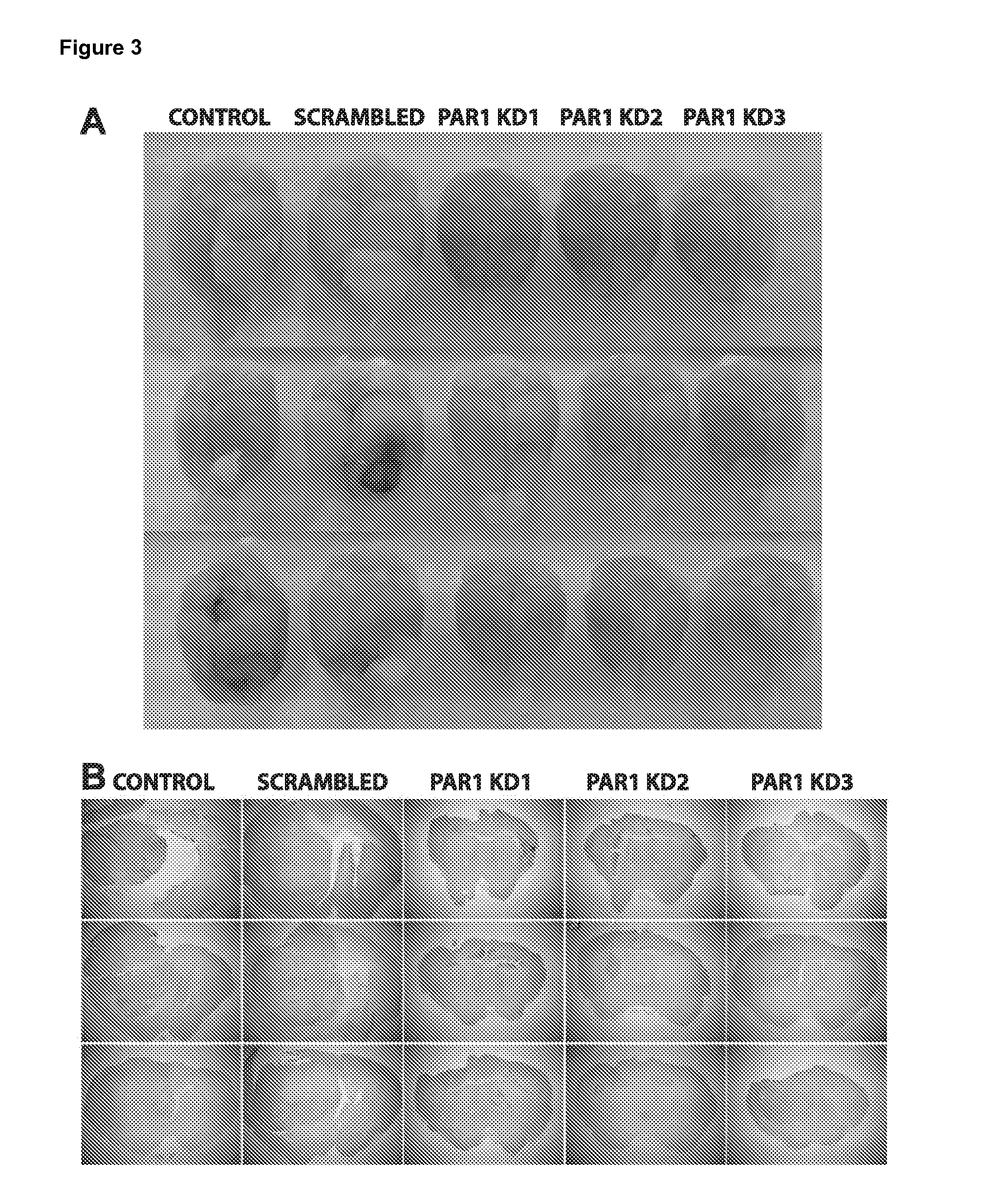 Use of inhibitors of binding between a par-1 receptor and its ligands for the treatment of glioma