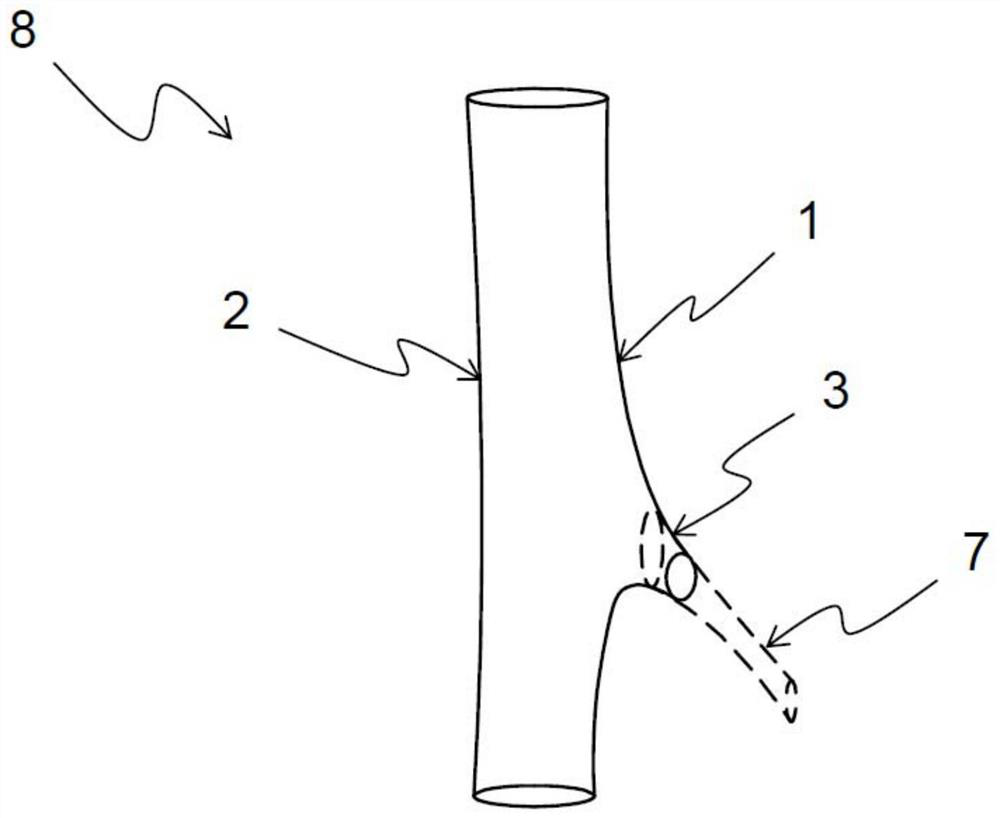 Bifurcated stent and stent system