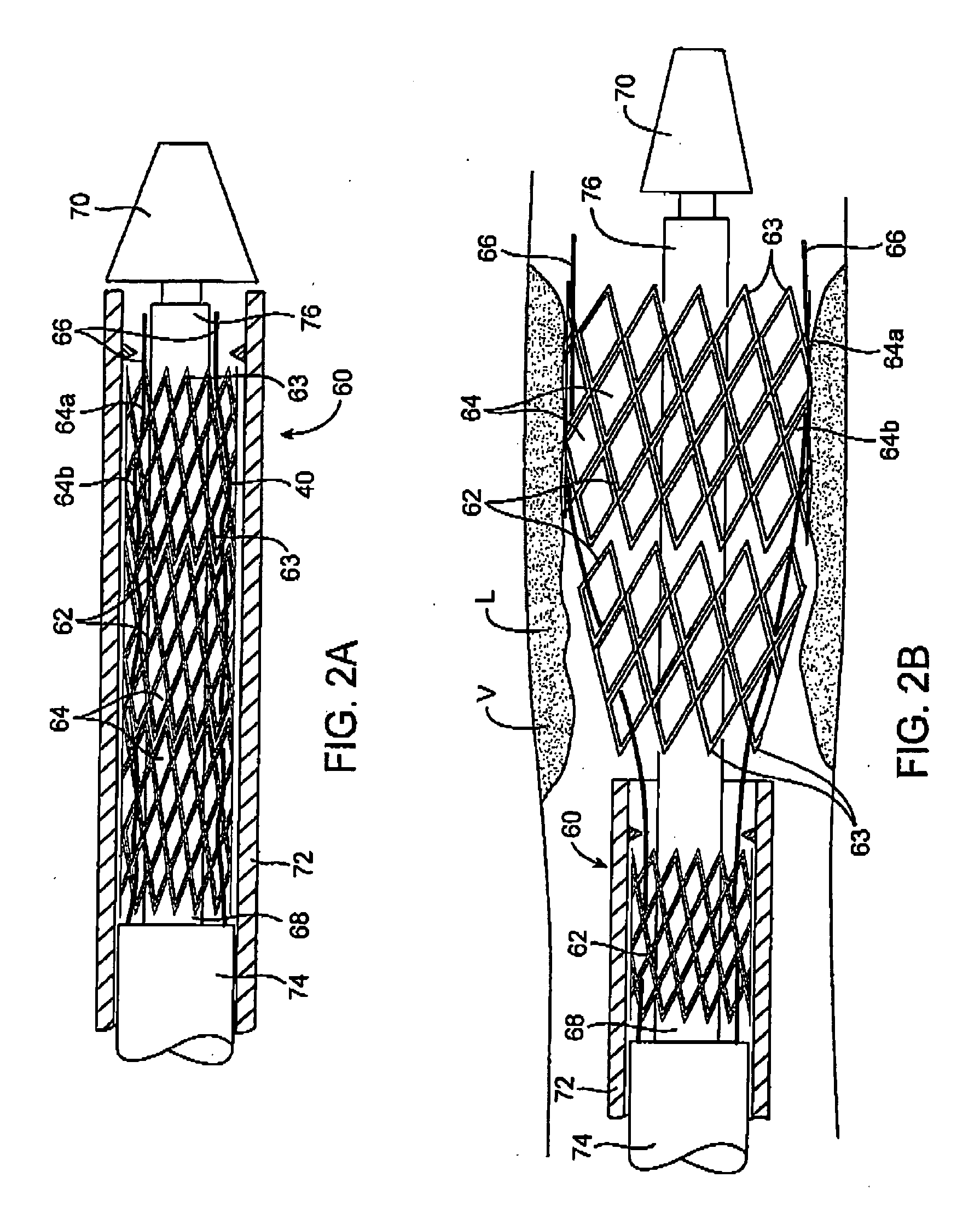 Devices and methods for controlling expandable prostheses during deployment