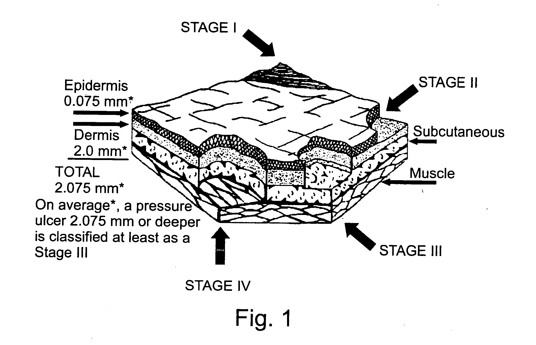 Method and system for determining a risk of ulcer onset
