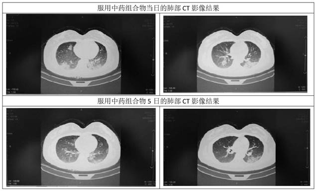 A kind of traditional Chinese medicine composition and its application