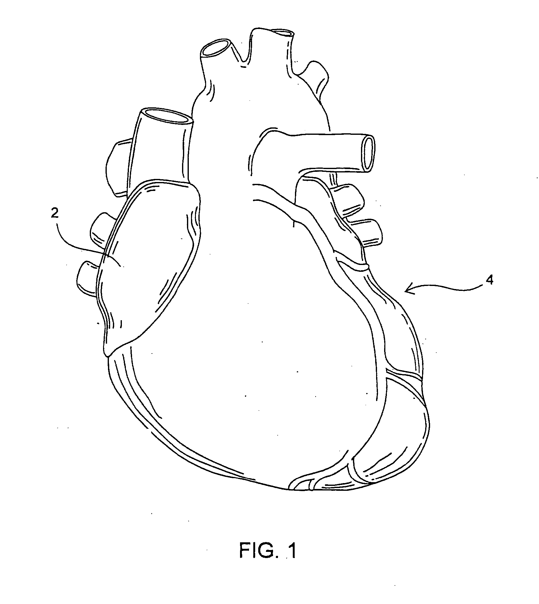 Pass-through restraint electrolytic implant delivery systems