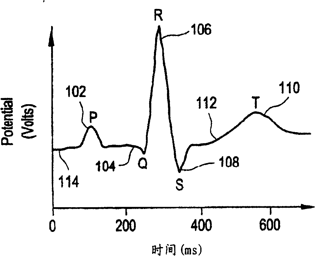 Method and system for improved measurement of t-wave alternative