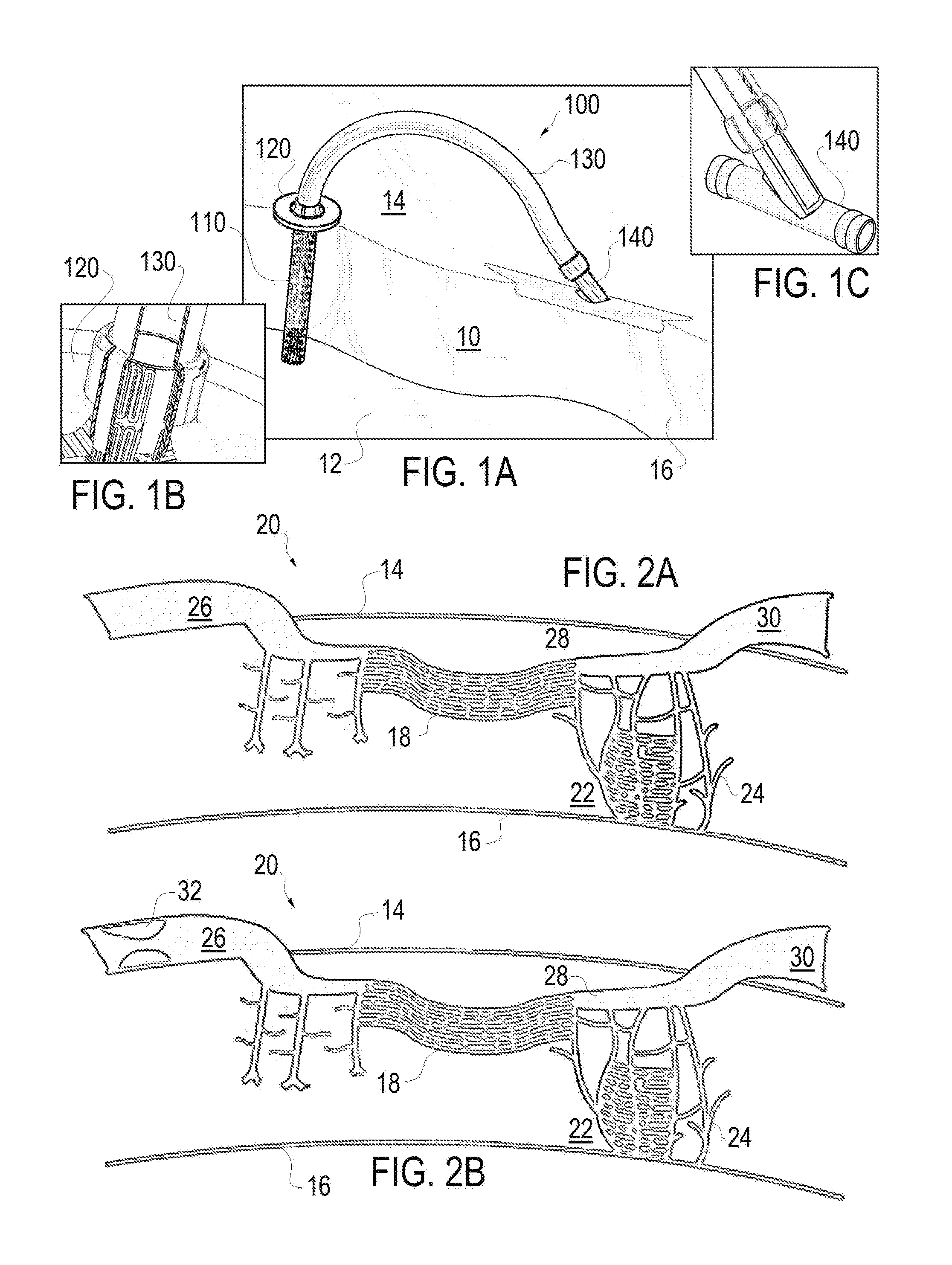 Method and apparatus for coupling left ventricle of the heart to the anterior interventricular vein to stimulate collateral development in ischemic regions