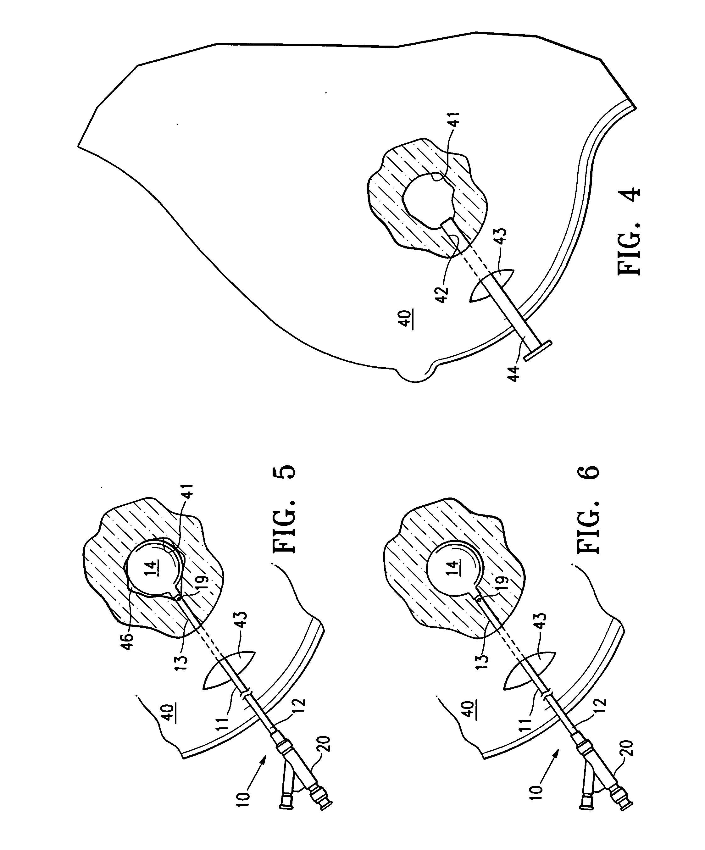 Temporary catheter for biopsy site tissue fixation